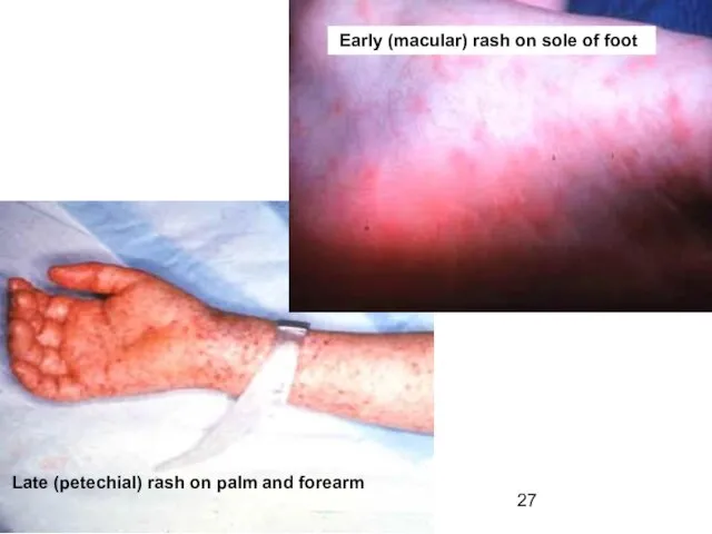 Early (macular) rash on sole of foot Late (petechial) rash on palm and forearm