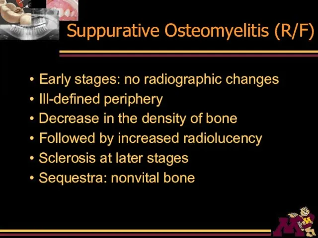 Suppurative Osteomyelitis (R/F) Early stages: no radiographic changes Ill-defined periphery Decrease in