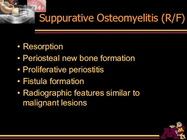 Suppurative Osteomyelitis (R/F) Resorption Periosteal new bone formation Proliferative periostitis Fistula formation
