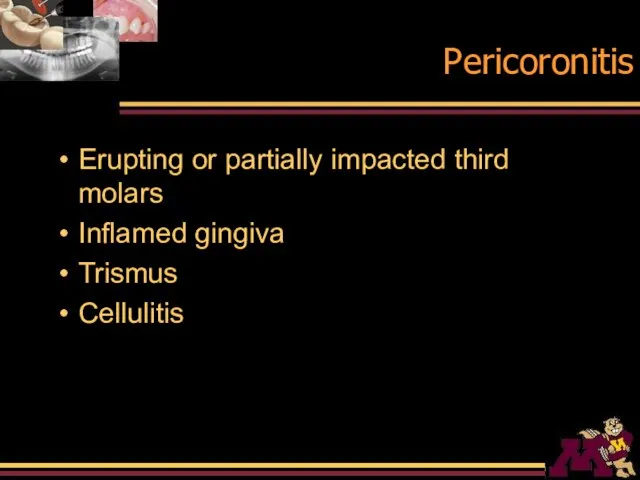 Pericoronitis Erupting or partially impacted third molars Inflamed gingiva Trismus Cellulitis