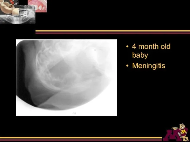 4 month old baby Meningitis