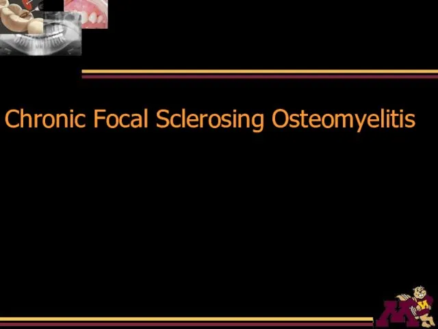 Chronic Focal Sclerosing Osteomyelitis