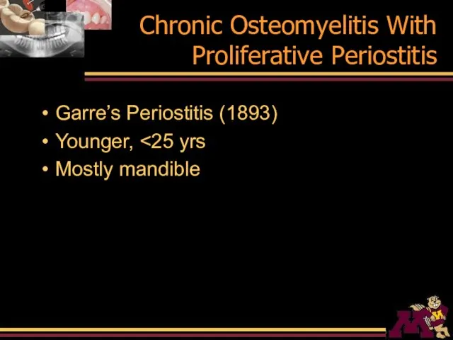 Chronic Osteomyelitis With Proliferative Periostitis Garre’s Periostitis (1893) Younger, Mostly mandible