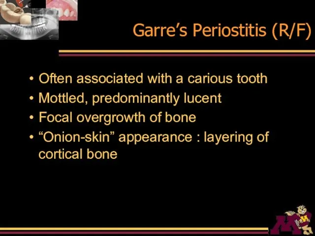 Garre’s Periostitis (R/F) Often associated with a carious tooth Mottled, predominantly lucent