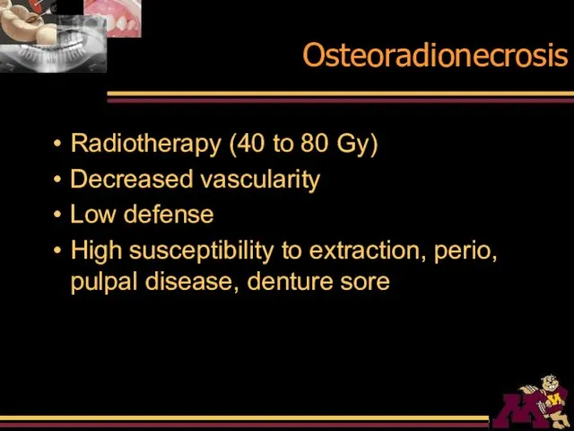Osteoradionecrosis Radiotherapy (40 to 80 Gy) Decreased vascularity Low defense High susceptibility