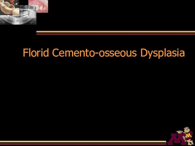 Florid Cemento-osseous Dysplasia