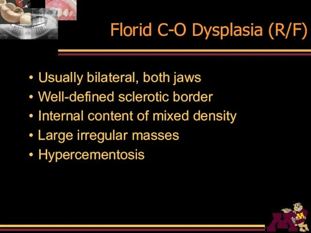 Florid C-O Dysplasia (R/F) Usually bilateral, both jaws Well-defined sclerotic border Internal