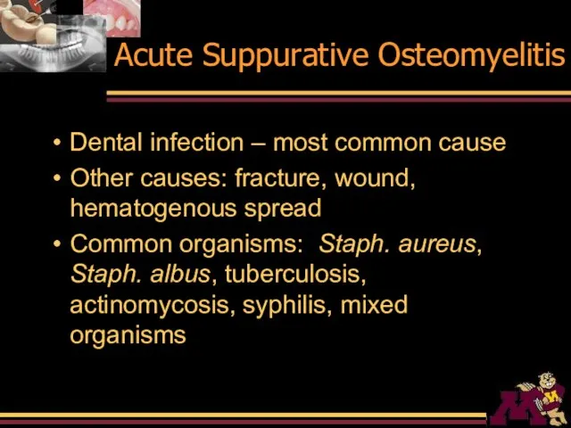 Acute Suppurative Osteomyelitis Dental infection – most common cause Other causes: fracture,