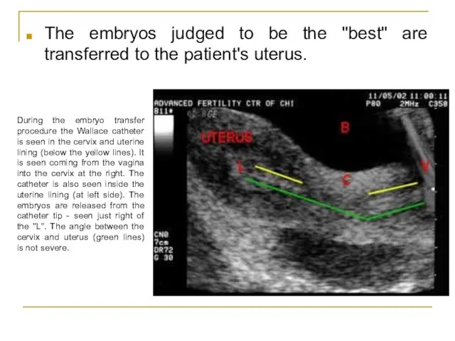 The embryos judged to be the "best" are transferred to the patient's