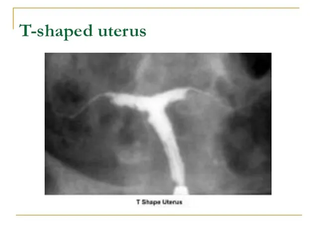 T-shaped uterus