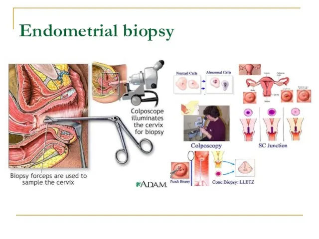 Endometrial biopsy