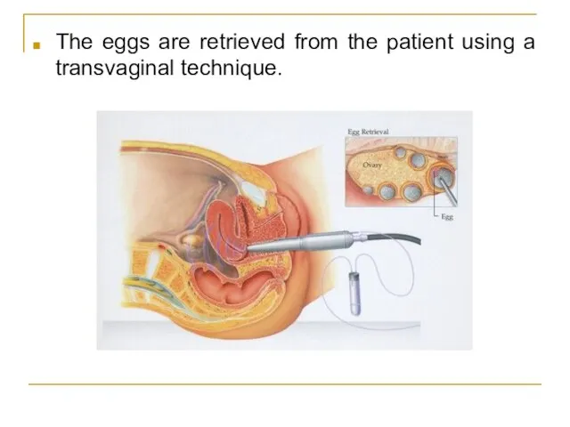 The eggs are retrieved from the patient using a transvaginal technique.