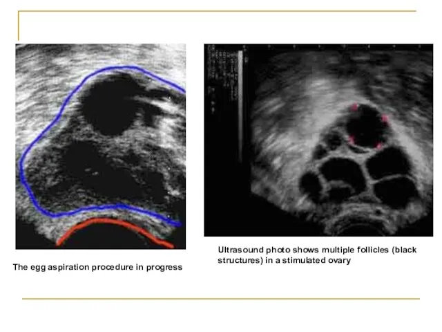 Ultrasound photo shows multiple follicles (black structures) in a stimulated ovary The