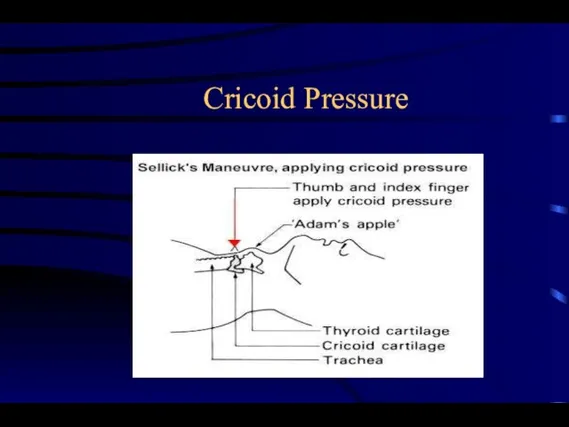 Cricoid Pressure