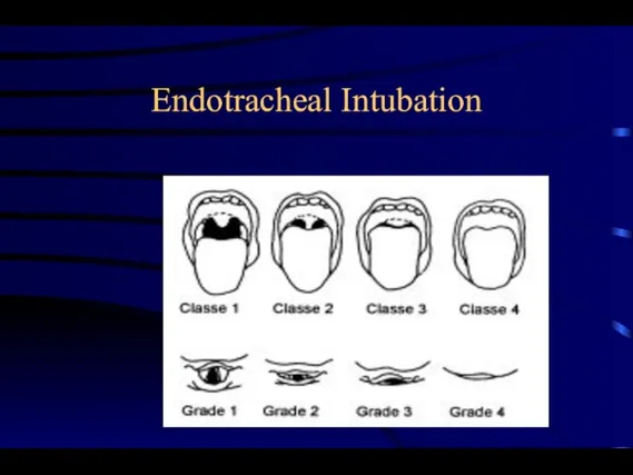 Endotracheal Intubation