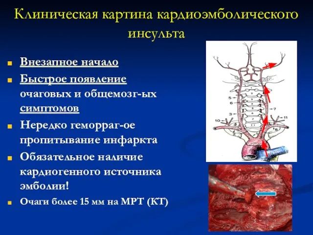 Внезапное начало Быстрое появление очаговых и общемозг-ых симптомов Нередко геморраг-ое пропитывание инфаркта