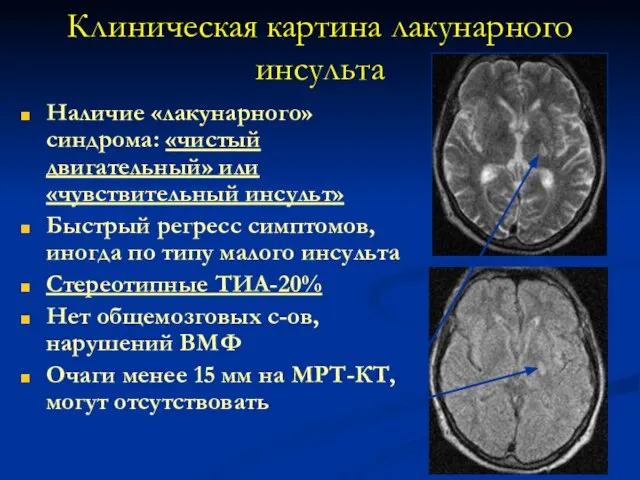 Клиническая картина лакунарного инсульта Наличие «лакунарного» синдрома: «чистый двигательный» или «чувствительный инсульт»