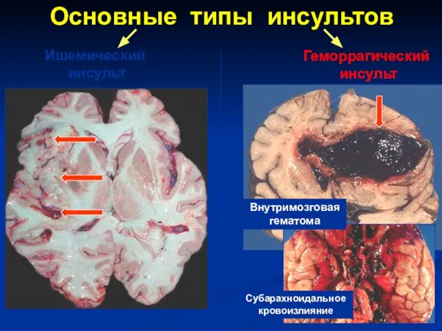 Основные типы инсультов Геморрагический инсульт Ишемический инсульт Субарахноидальное кровоизлияние Внутримозговая гематома