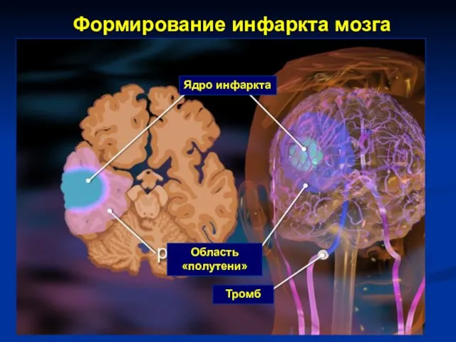 Формирование инфаркта мозга Ядро инфаркта Область «полутени» Тромб