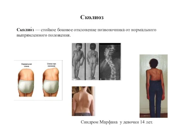 Сколиоз Синдром Марфана у девочки 14 лет. Сколио́з — стойкое боковое отклонение