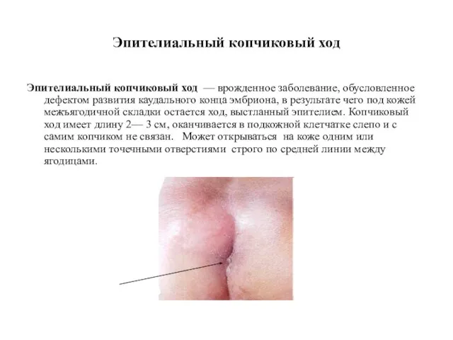 Эпителиальный копчиковый ход Эпителиальный копчиковый ход — врожденное заболевание, обусловленное дефектом развития