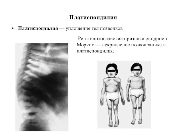 Платиспондилия Платиспондилия — уплощение тел позвонков. Рентгенологические признаки синдрома Моркио — искривление позвоночника и платиспондилия.