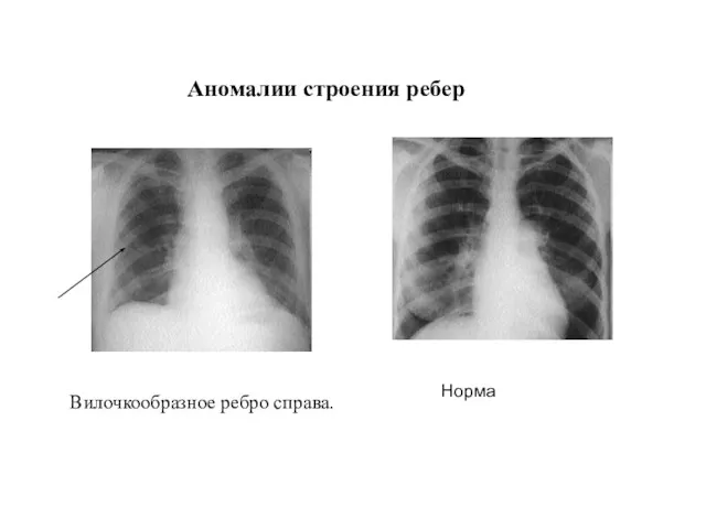 Аномалии строения ребер Вилочкообразное ребро справа. Норма