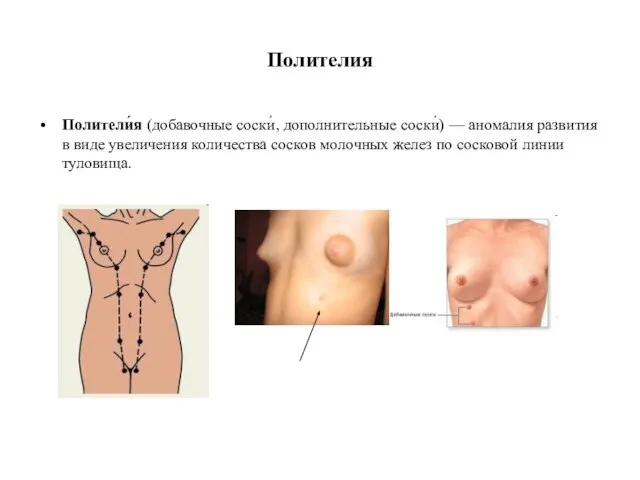 Полителия Полители́я (добавочные соски́, дополнительные соски́) — аномалия развития в виде увеличения