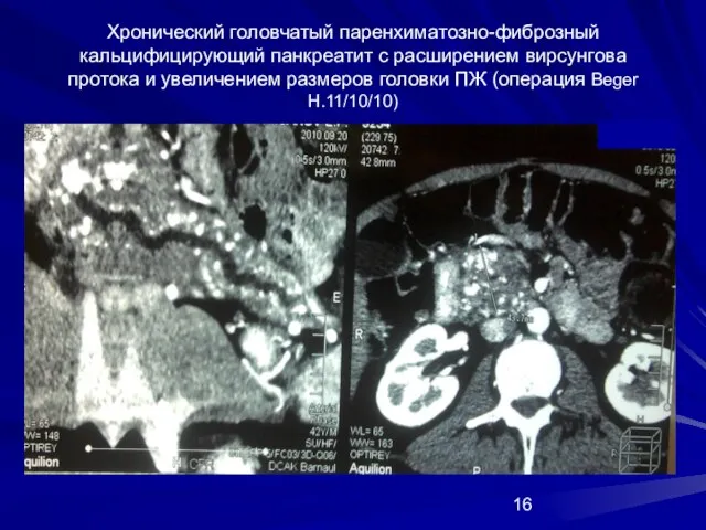 Хронический головчатый паренхиматозно-фиброзный кальцифицирующий панкреатит с расширением вирсунгова протока и увеличением размеров