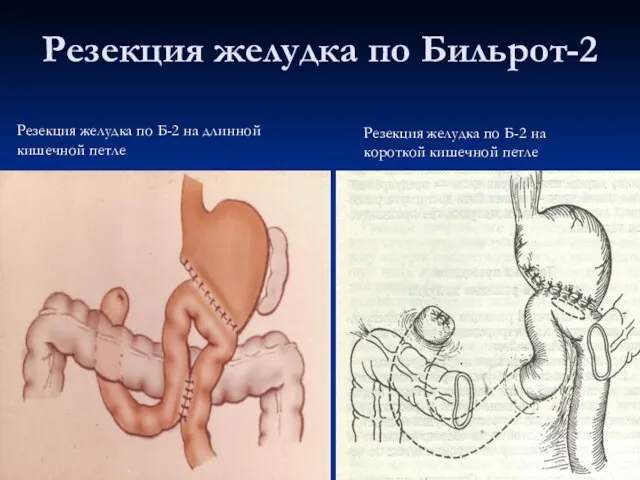 Резекция желудка по Бильрот-2 Резекция желудка по Б-2 на длинной кишечной петле