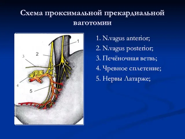 Схема проксимальной прекардиальной ваготомии 1. N.vagus anterior; 2. N.vagus posterior; 3. Печёночная