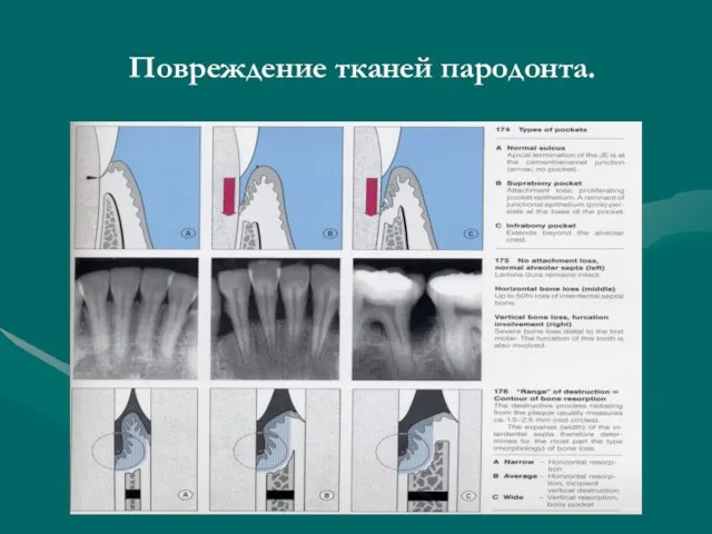 Повреждение тканей пародонта.