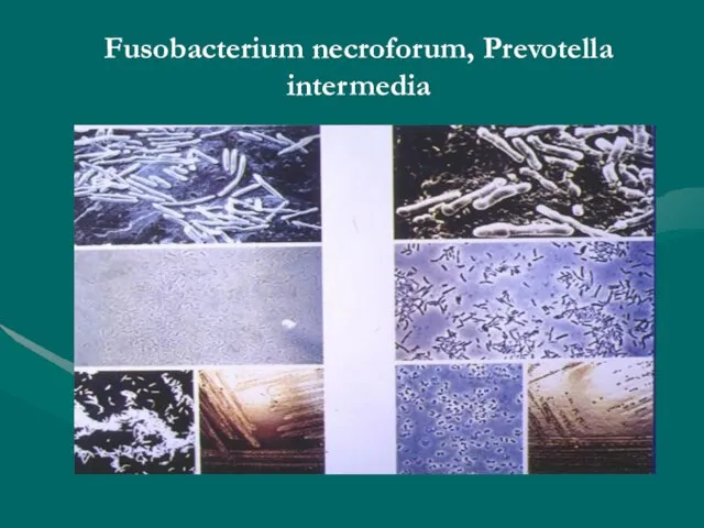 Fusobacterium necroforum, Prevotella intermedia