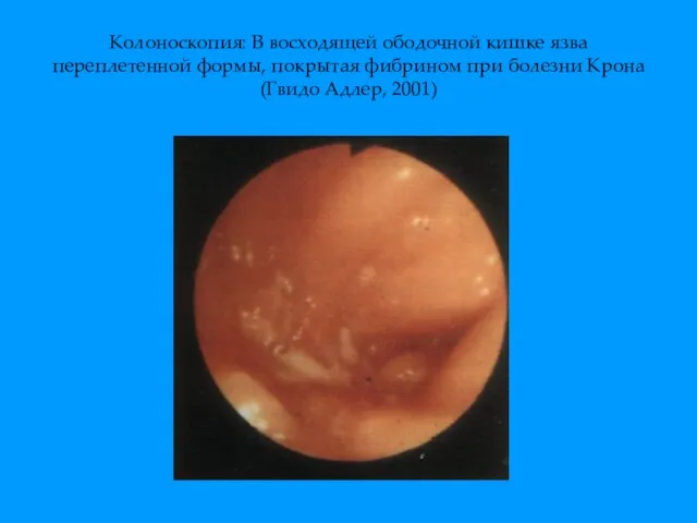 Колоноскопия: В восходящей ободочной кишке язва переплетенной формы, покрытая фибрином при болезни Крона (Гвидо Адлер, 2001)