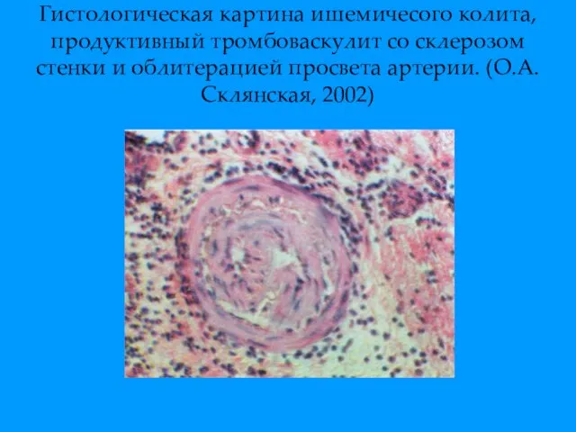 Гистологическая картина ишемичесого колита, продуктивный тромбоваскулит со склерозом стенки и облитерацией просвета артерии. (О.А.Склянская, 2002)