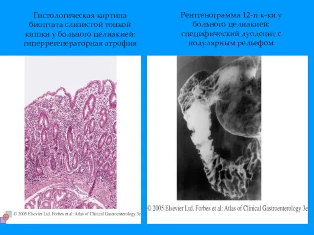 Гистологическая картина биоптата слизистой тонкой кишки у больного целиакией: гиперрегенераторная атрофия Рентгенограмма