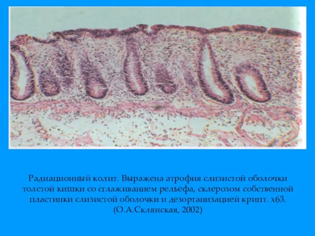 Радиационный колит. Выражена атрофия слизистой оболочки толстой кишки со сглаживанием рельефа, склерозом