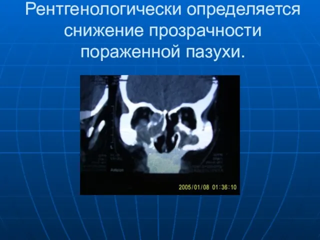 Рентгенологически определяется снижение прозрачности пораженной пазухи.