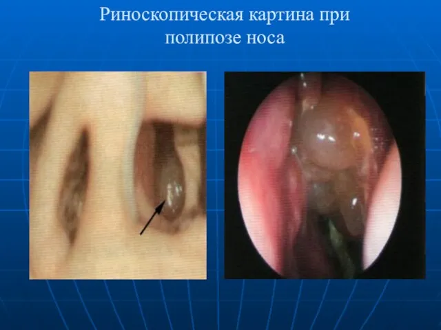 Риноскопическая картина при полипозе носа