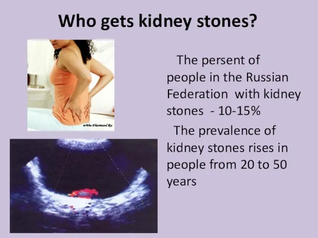 Who gets kidney stones? The persent of people in the Russian Federation