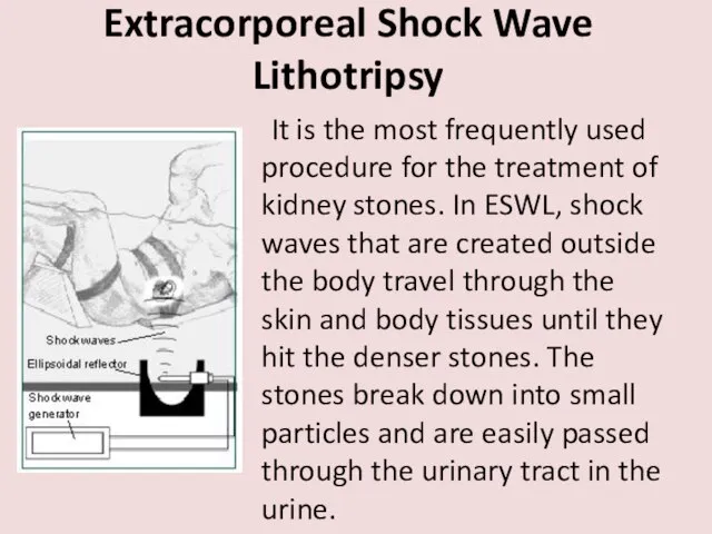 Extracorporeal Shock Wave Lithotripsy It is the most frequently used procedure for