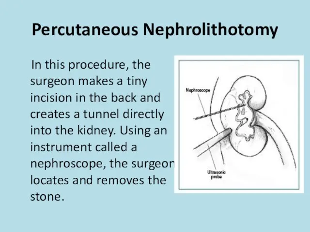 Percutaneous Nephrolithotomy In this procedure, the surgeon makes a tiny incision in