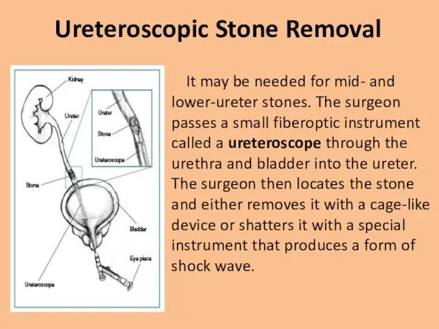 Ureteroscopic Stone Removal It may be needed for mid- and lower-ureter stones.
