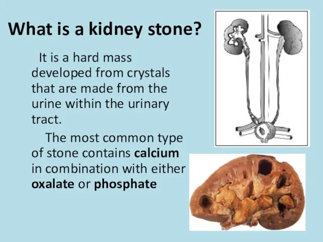 What is a kidney stone? It is a hard mass developed from