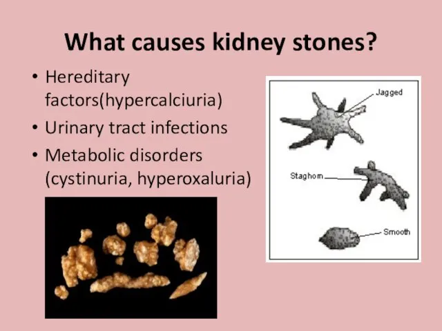 What causes kidney stones? Hereditary factors(hypercalciuria) Urinary tract infections Metabolic disorders (cystinuria, hyperoxaluria)