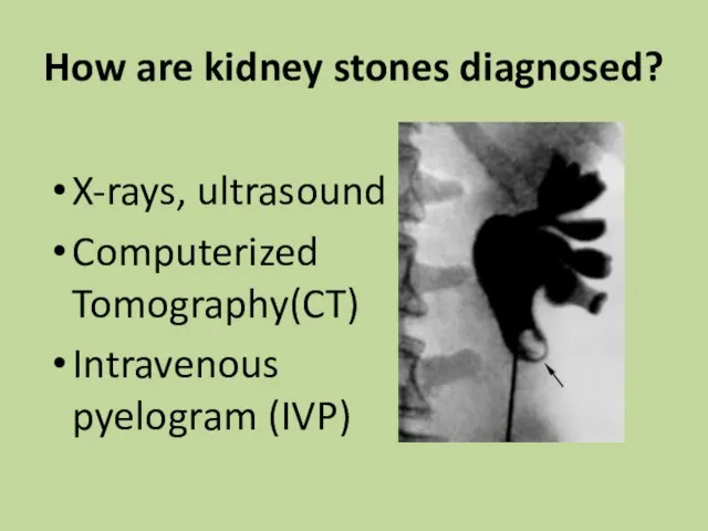 How are kidney stones diagnosed? X-rays, ultrasound Computerized Tomography(CT) Intravenous pyelogram (IVP)