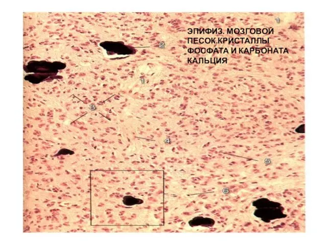 ЭПИФИЗ. МОЗГОВОЙ ПЕСОК.КРИСТАЛЛЫ ФОСФАТА И КАРБОНАТА КАЛЬЦИЯ