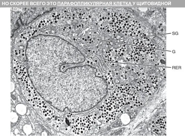 НО СКОРЕЕ ВСЕГО ЭТО ПАРАФОЛЛИКУЛЯРНАЯ КЛЕТКА У ЩИТОВИДНОЙ ЖЕЛЕЗЫ