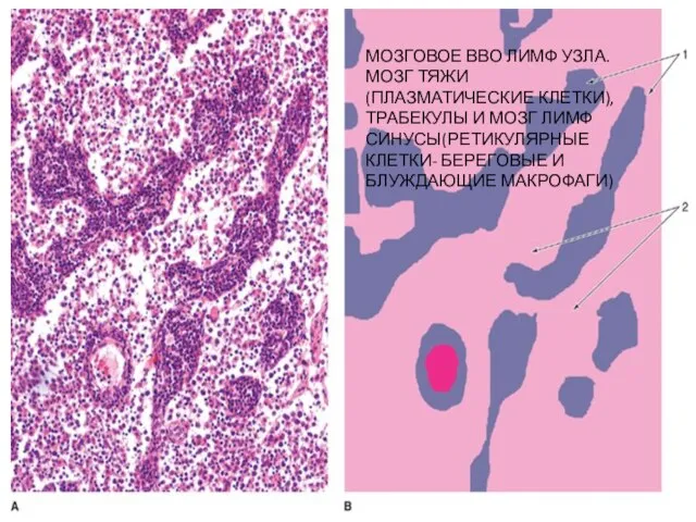 МОЗГОВОЕ ВВО ЛИМФ УЗЛА. МОЗГ ТЯЖИ(ПЛАЗМАТИЧЕСКИЕ КЛЕТКИ),ТРАБЕКУЛЫ И МОЗГ ЛИМФ СИНУСЫ(РЕТИКУЛЯРНЫЕ КЛЕТКИ- БЕРЕГОВЫЕ И БЛУЖДАЮЩИЕ МАКРОФАГИ)