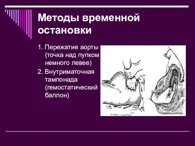 Методы временной остановки 1. Пережатие аорты (точка над пупком и немного левее)